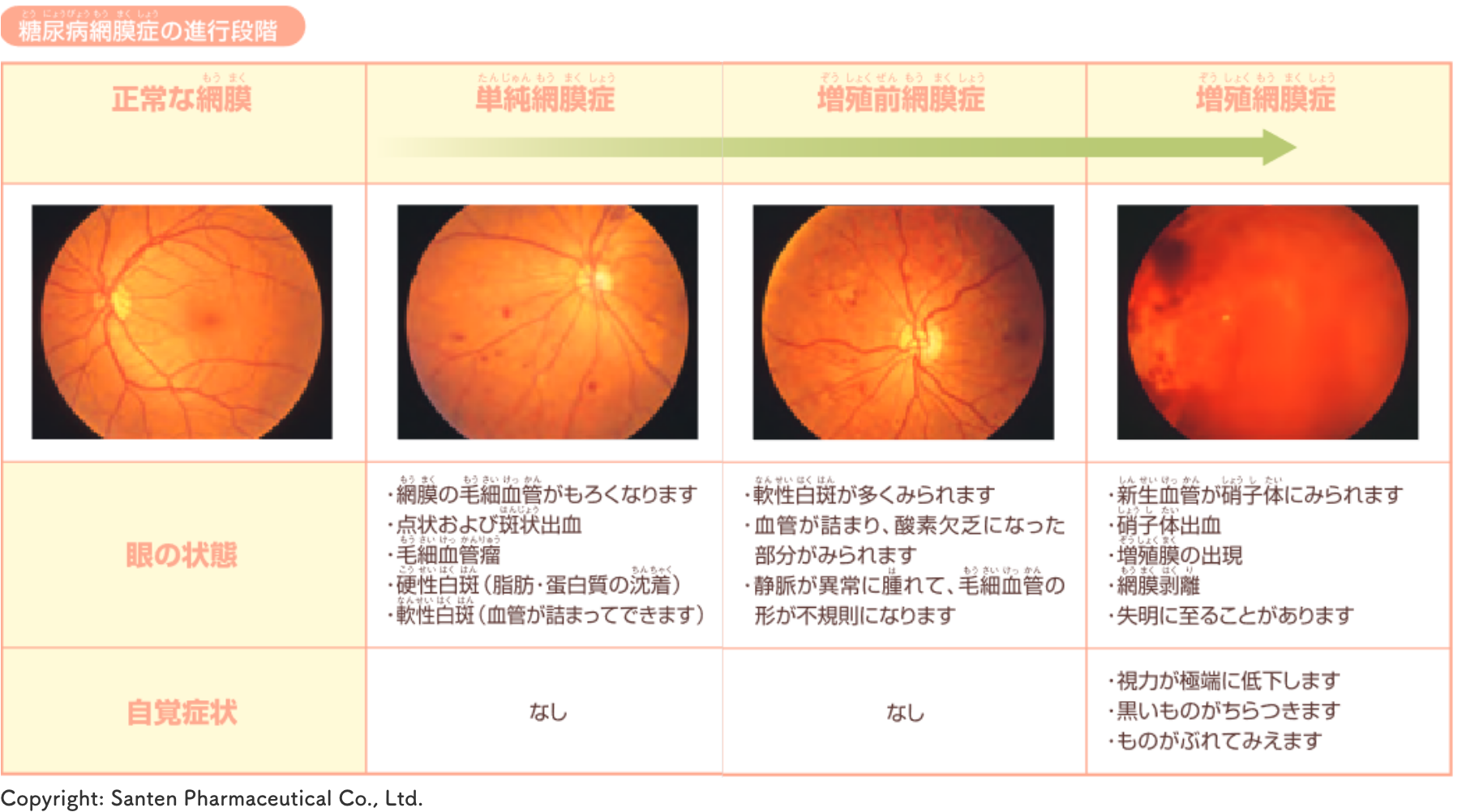 糖尿病網膜症-眼科 - 医療法人すみれ会 今井クリニック